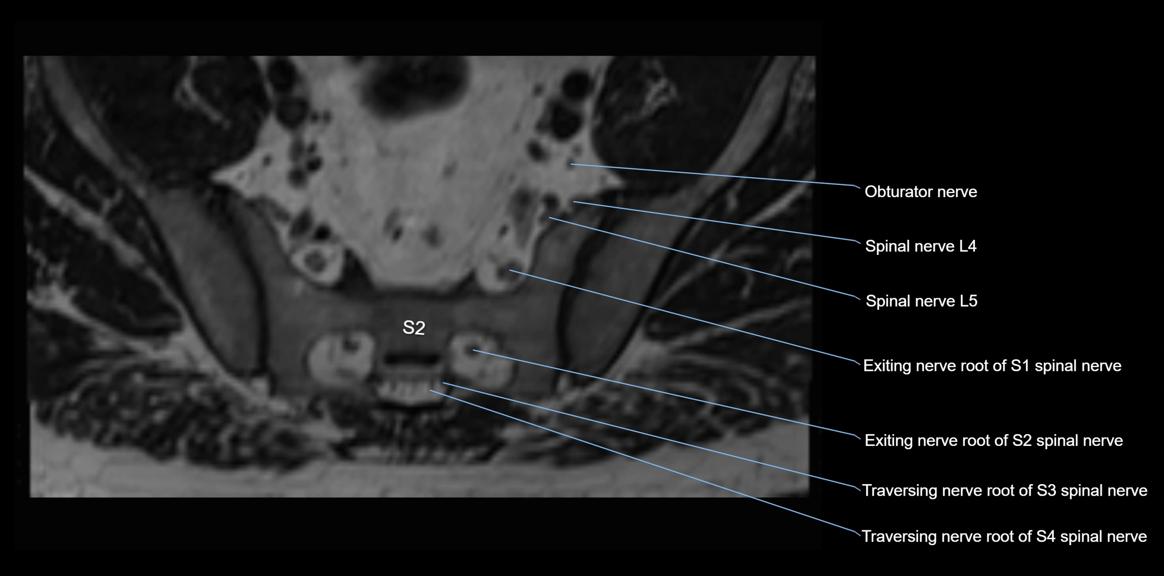 MR lumbosacral plexus axial cross sectional anatomy 3T  radiology  image-img-1008001-00085.webp